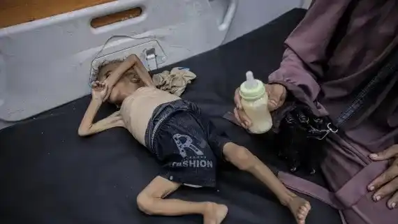 Un niño palestino con desnutrición severa yace en una cama de hospital en el Hospital Amigos del Paciente en la ciudad de Gaza. [Ahmed Jihad Ibrahim Al-arini/Anadolu]