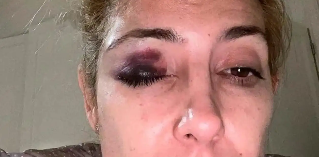En otra imagen aparece con un gel frío para atenuar el moretón.