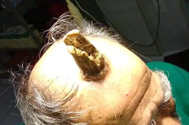 Insólito: se golpeó la cabeza y le creció un cuerno