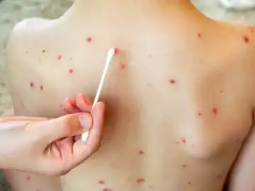 Elevan la vigilancia epidemiológica en la provincia por un caso de sarampión en Entre Ríos