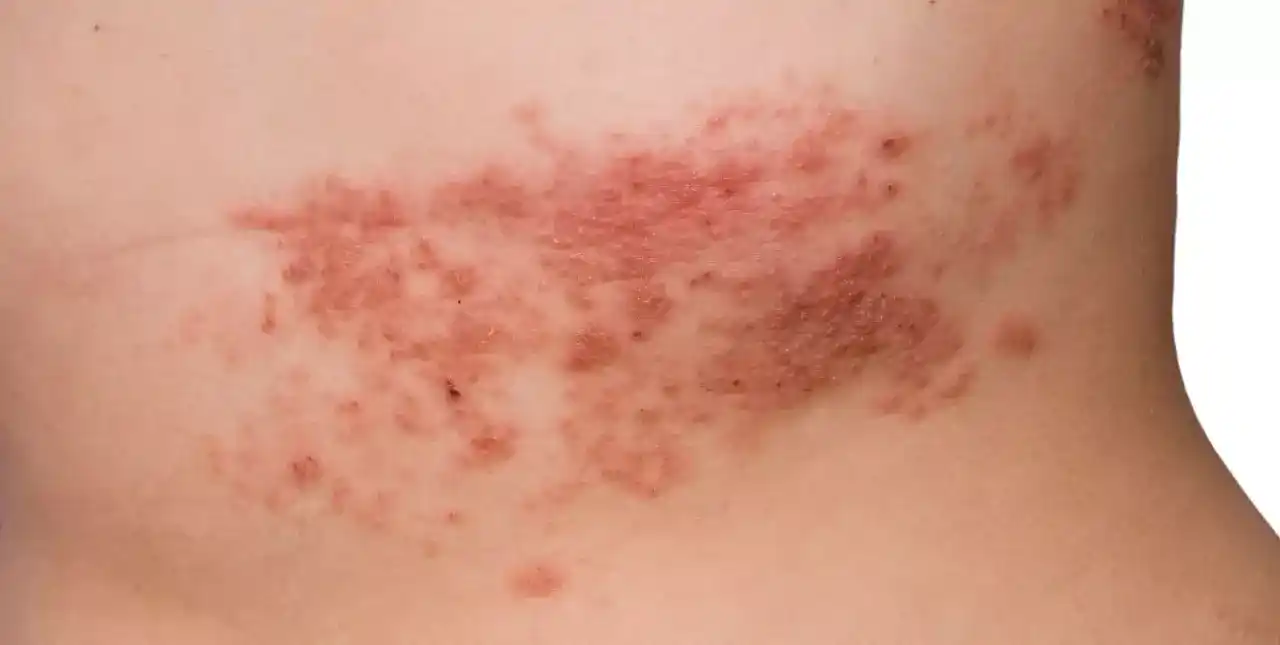 Anmat aprobó para Argentina una nueva vacuna para prevenir la “culebrilla”