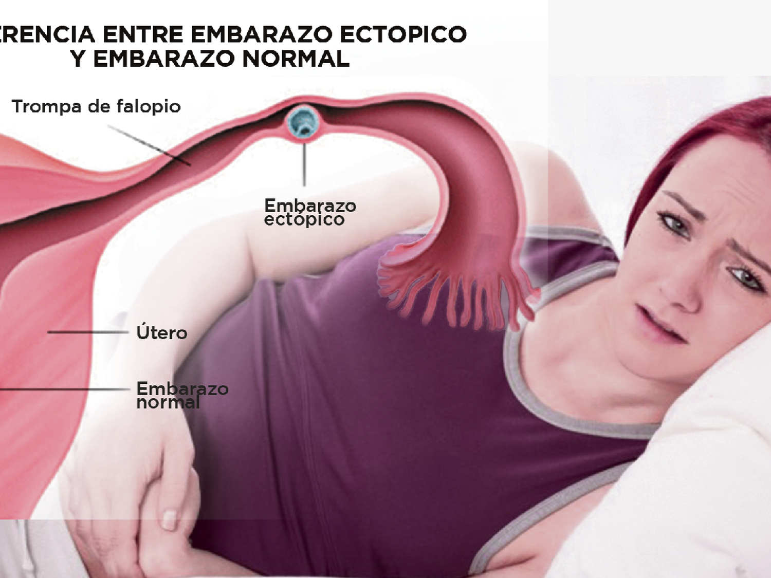 Qué es un embarazo ectópico y cómo reconocer los síntomas