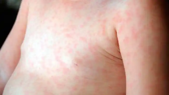 Fueron notificados cuatro nuevos casos de sarampión en la Argentina