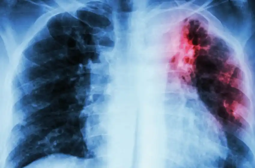 A 103 años de la primera vacunación contra la tuberculosis