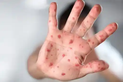 Viruela del mono: una enfermedad poco frecuente, que se remonta a los tiempos de los egipcios