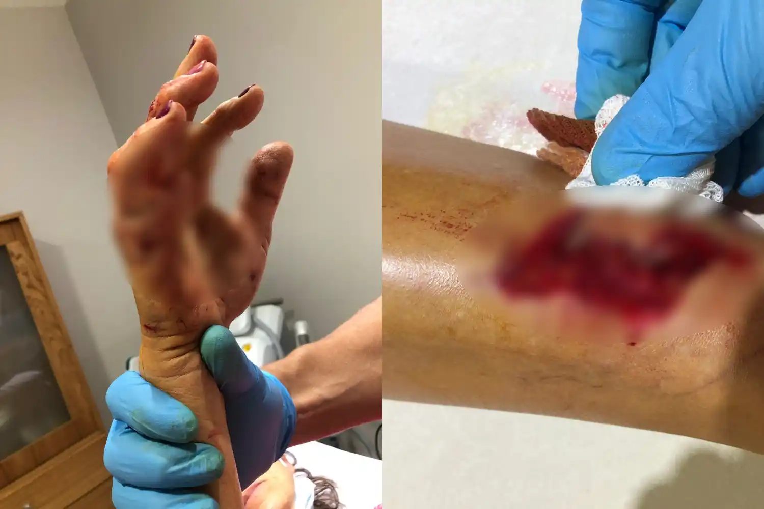 Dos perros atacaron a una mujer de 60 años: le aplicaron “como 50 puntos” de sutura