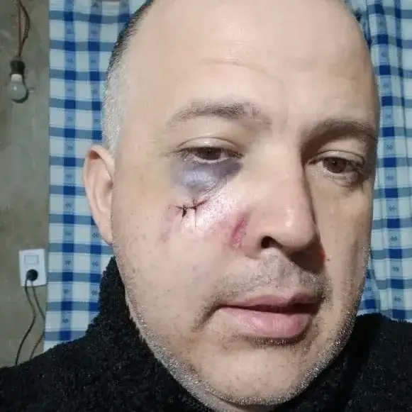 luis romero chofer agredido sufrió fractura de pómulo