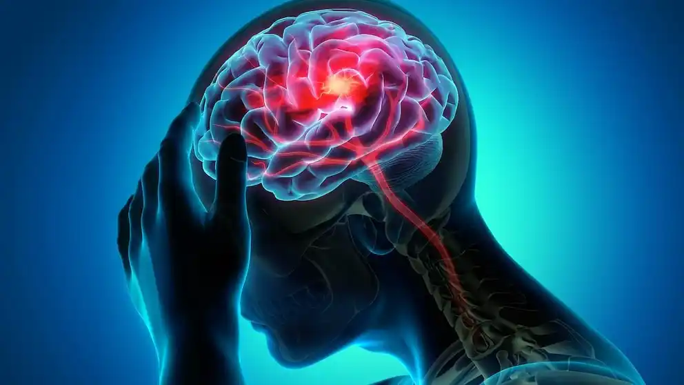 La sigla ACV. Significa “ataque cerebrovascular”, explicó el neurocirujano Juan Baldovino
