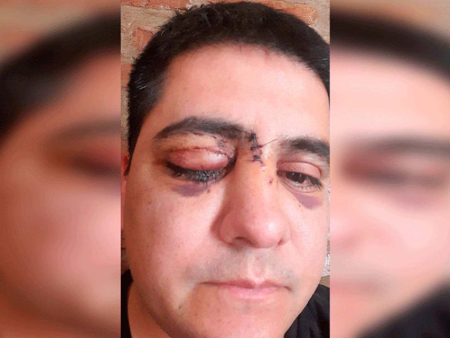 “Esto me cambió la vida”, dijo el policía que perdió un ojo en operativo en barrio Acapulco