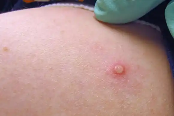 Confirman que dio negativo de viruela símica el test realizado al tripulante del barco