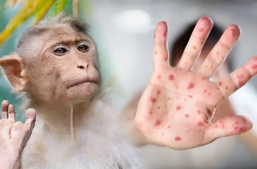 Viruela del mono en Rosario: Habría un segundo caso confirmado