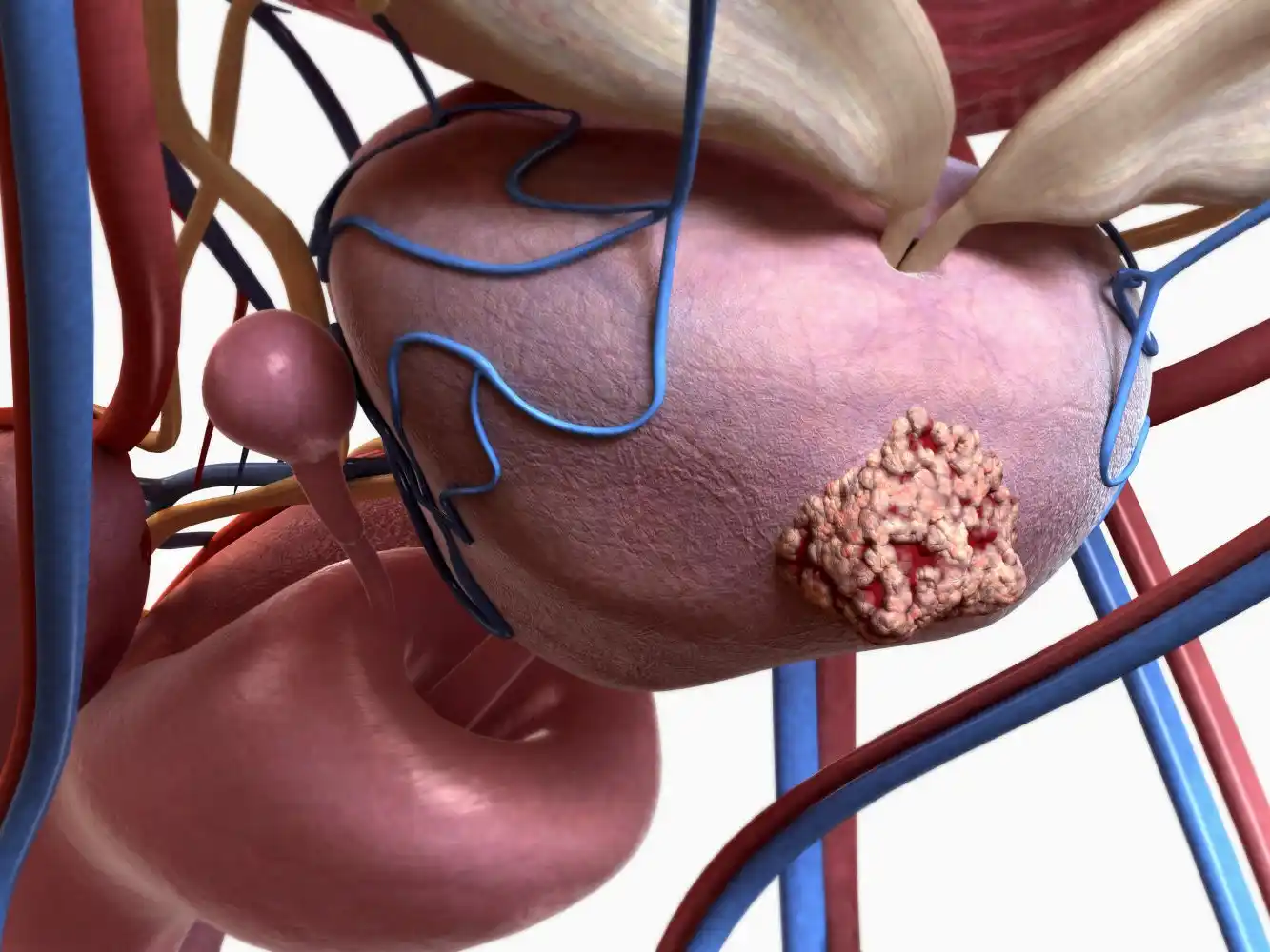 Cáncer de próstata: 7 de cada 10 diagnósticos llegan tarde