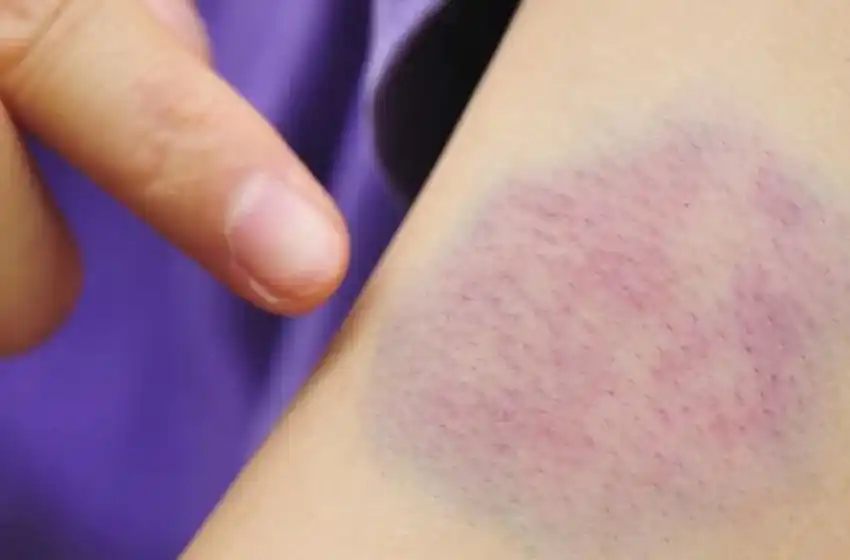 Leucemia: tipos, síntomas y tratamientos