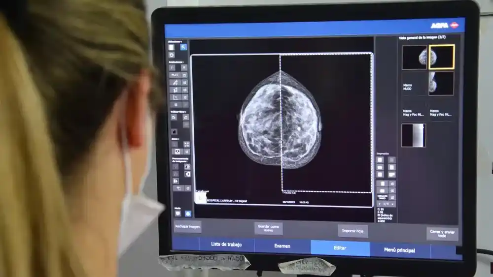 Hasta el momento, el tamizaje nacional comenzaba recién a los 50 años.