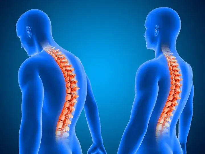 Escoliosis: chequeos y actividad física, claves para cuidar la columna en niños y adolescentes