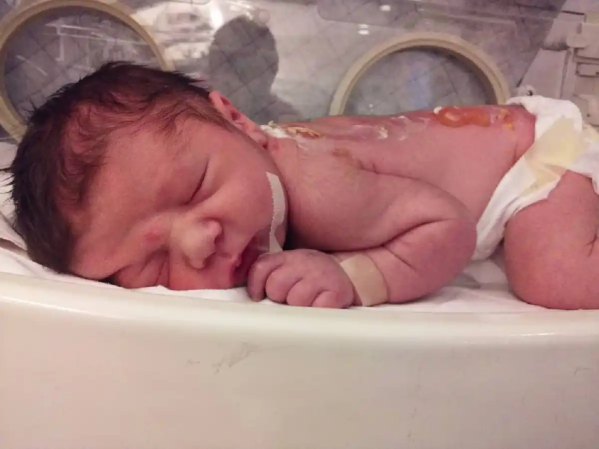 “Elías va mejorando”, dijo el papá del bebé quemado 