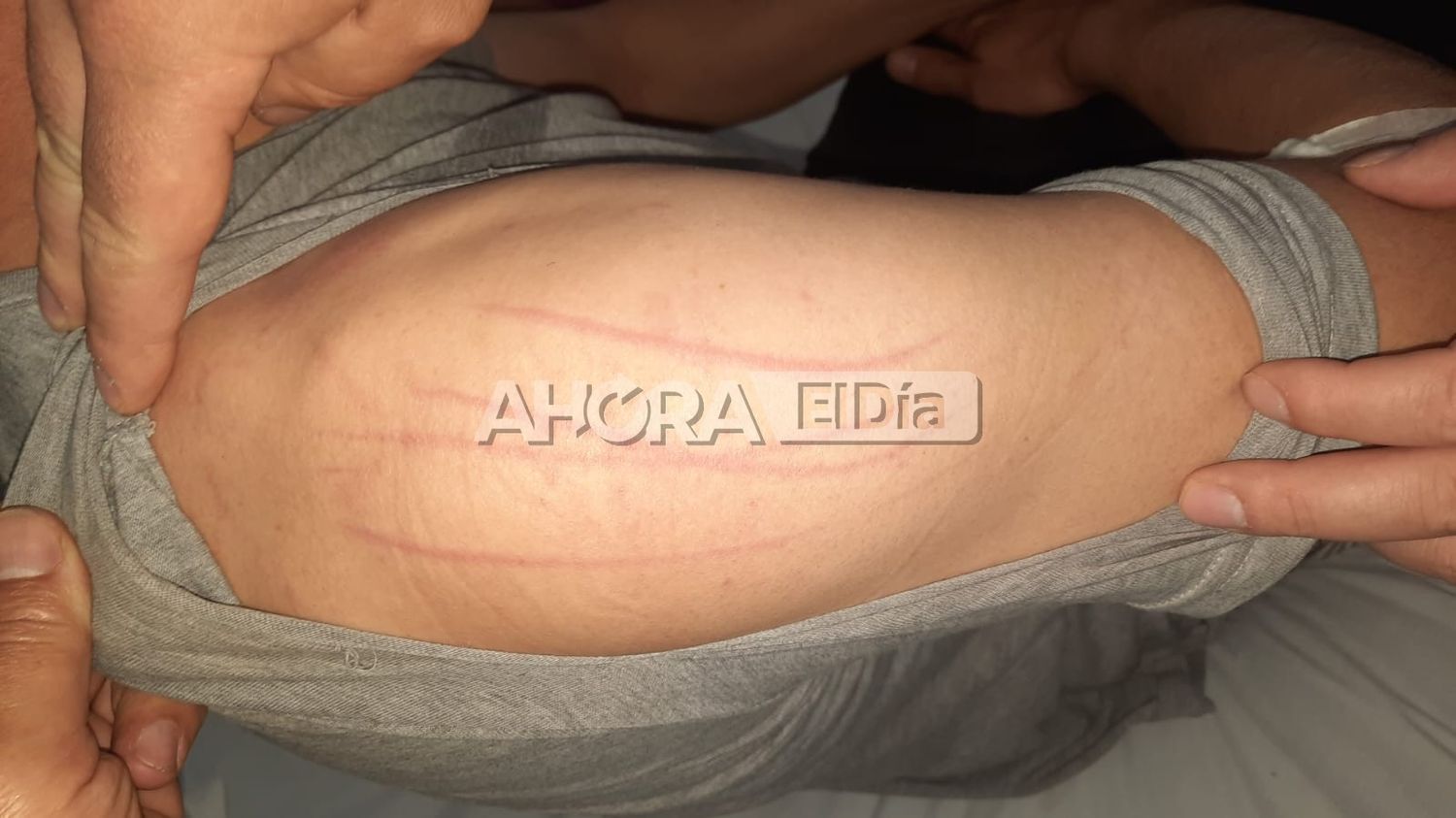 Terribles rasguños y marcas en la piel: así quedó el policía que aseguró ser atacado por un ente maligno
