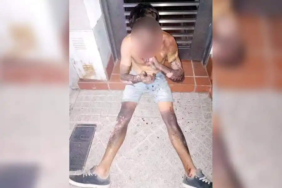 Falleció el joven con el 80% del cuerpo quemado al robar cables en Rosario después de 16 días de agonía
