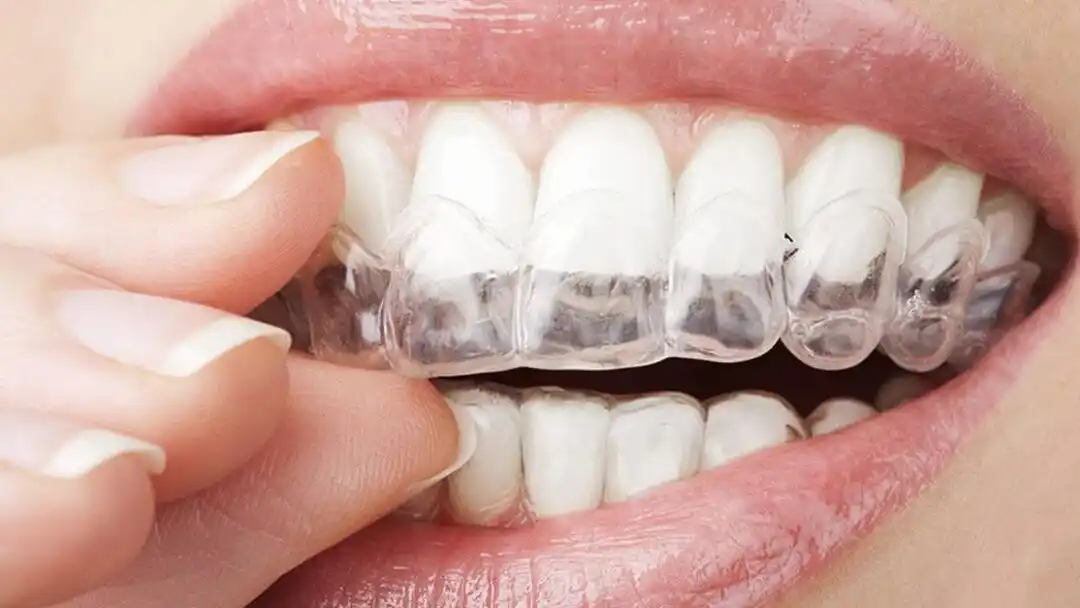 Bruxismo: cómo detectarlo a tiempo y qué hacer para evitar daños en la mandíbula