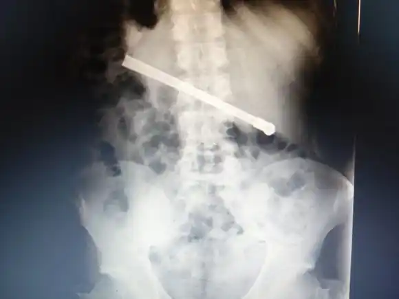 Tuvieron que operar a un preso que se tragó una bombilla