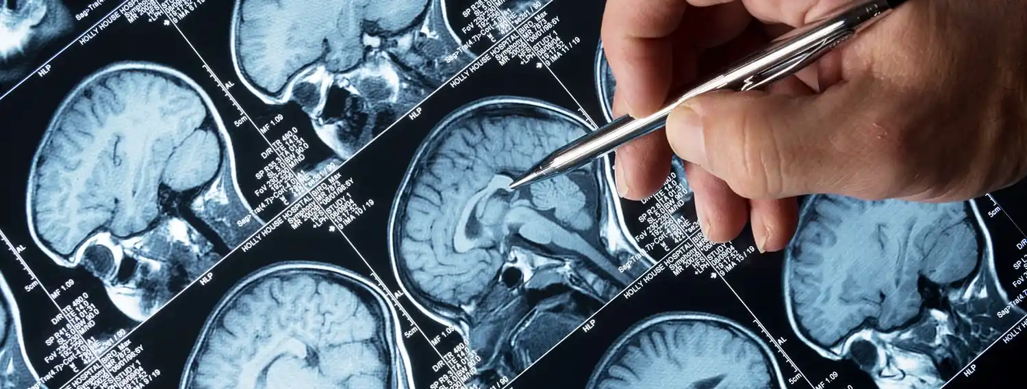 24 de mayo: Día internacional contra la epilepsia