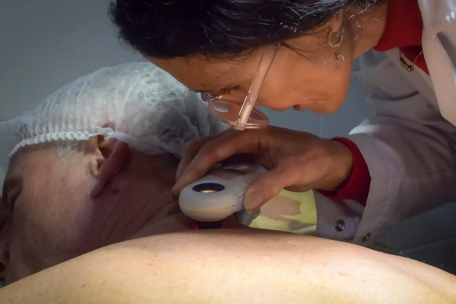 Salud promueve la consulta temprana de revisión de lesiones para prevenir el cáncer de piel