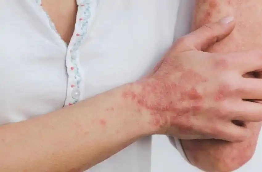 Arrancan jornadas de detección gratuita de psoriasis en la plaza Sarmiento