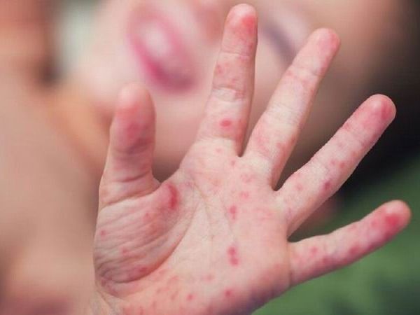 Reiteran cuidados para prevenir la enfermedad
conocida como síndrome mano-ano-boca