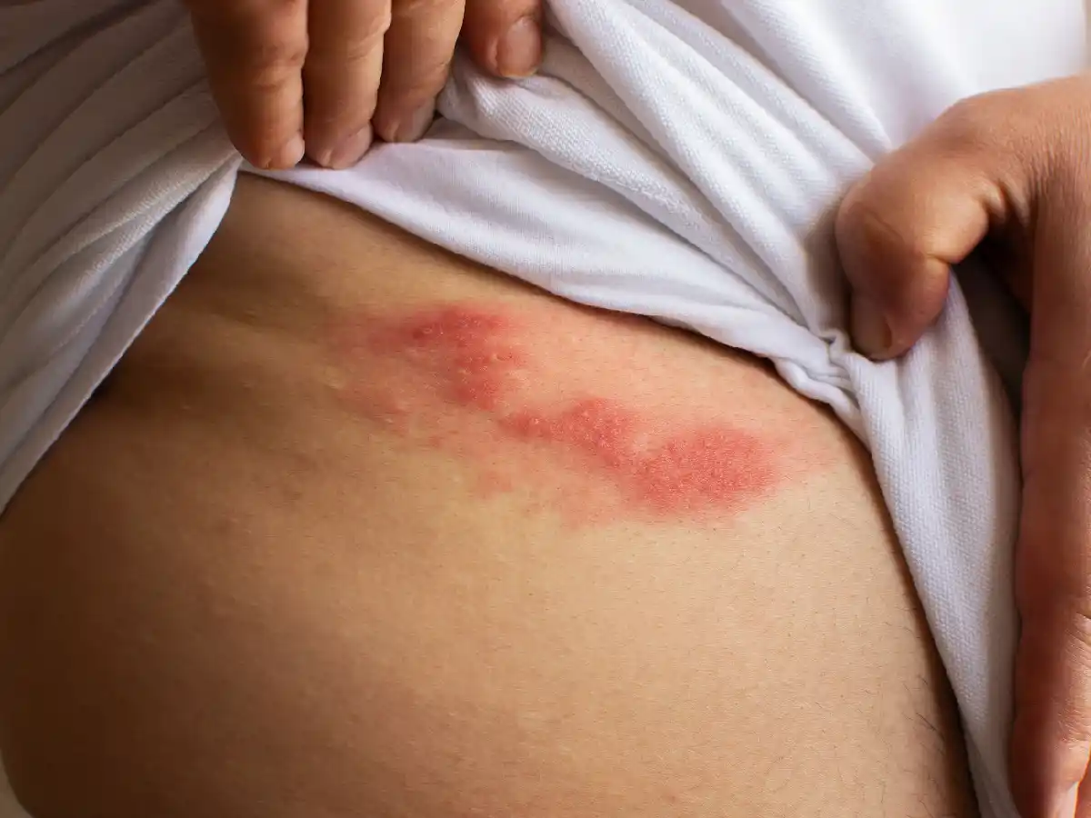 Por qué es importante vacunarnos contra el virus que causa la culebrilla 