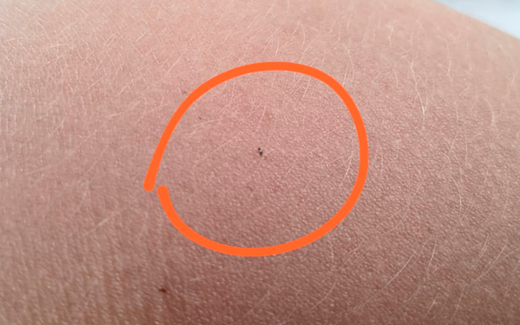 Invasión de bichitos que pican: crecen las consultas dermatológicas