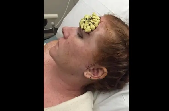"Dejen de tomar sol": la dura de batalla de una mujer contra el cáncer de piel