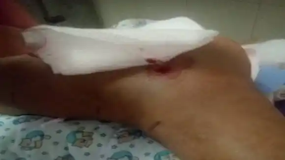 EL SEGUNDO CASO EN UNA SEMANA: niña mordida por una mapanare en Trujillo urge por suero antiofídico