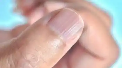 ¿Por qué aparecen rayas en las uñas?