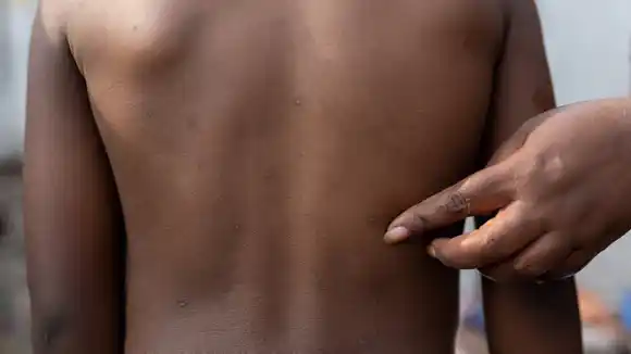 Más de 18.700 casos de Mpox en África desde principios de año