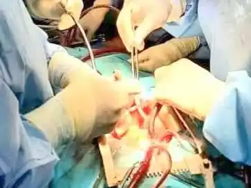 El HAC reafirmó su nivel de excelencia 
con una exitosa cirugía de disección aórtica