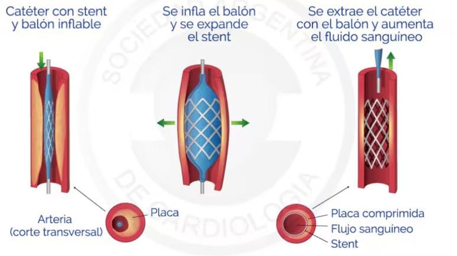 stent cardiólogos - 2