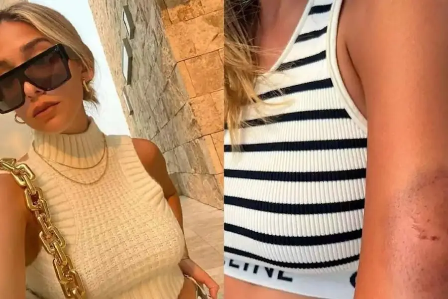 Violento robo a una influencer argentina en Brasil: la mordieron para sacarle el celular