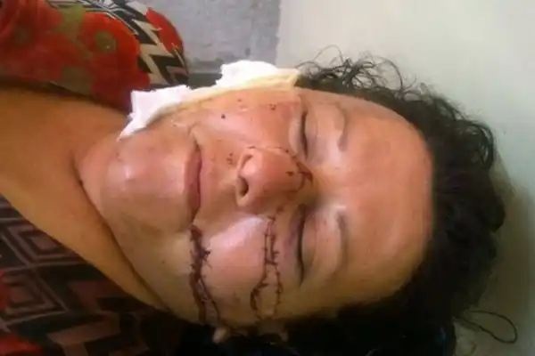 Un hombre quemó a su ex pareja con agua hirviendo y luego la apuñaló en la cara