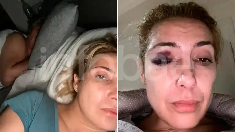 Las nuevas fotos de Fabiola Yañez con golpes en su cara