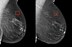 IA puede identificar mujeres con RIESGO ELEVADO DE CÁNCER DE MAMA varios años antes del diagnóstico