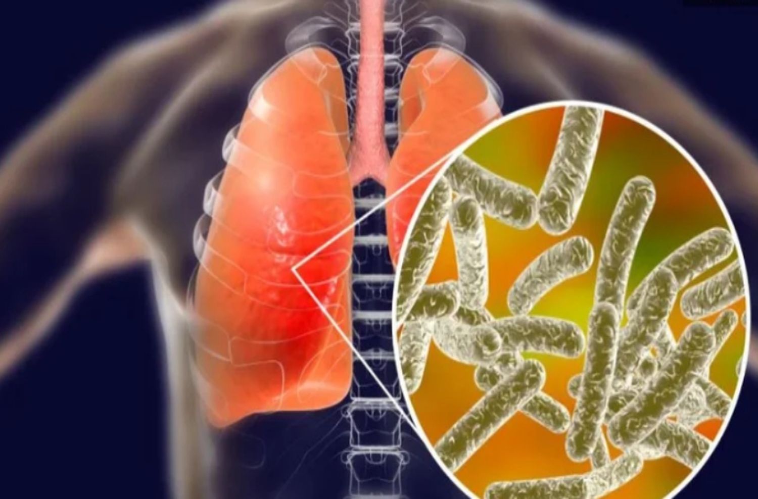Tucumán: confirmaron una quinta muerte por neumonía a causa de la bacteria Legionella