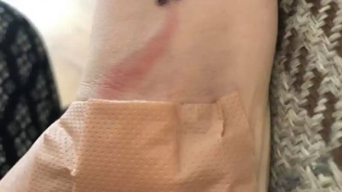 Vio una extraña marca en su hijo y gracias a su rápida reacción le salvó la vida