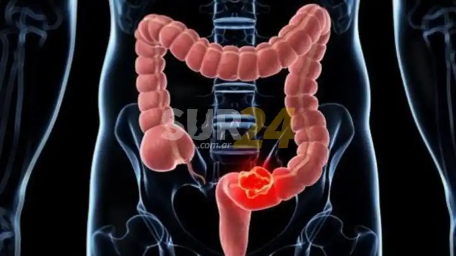 Una dieta poco saludable impacta en el desarrollo del cáncer de colon