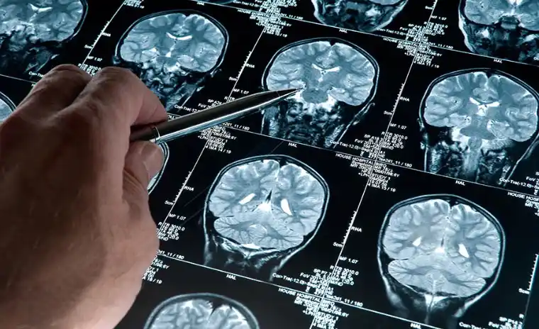 Científicos de la UBA investigan cómo detectar el alzheimer con inteligencia artificial