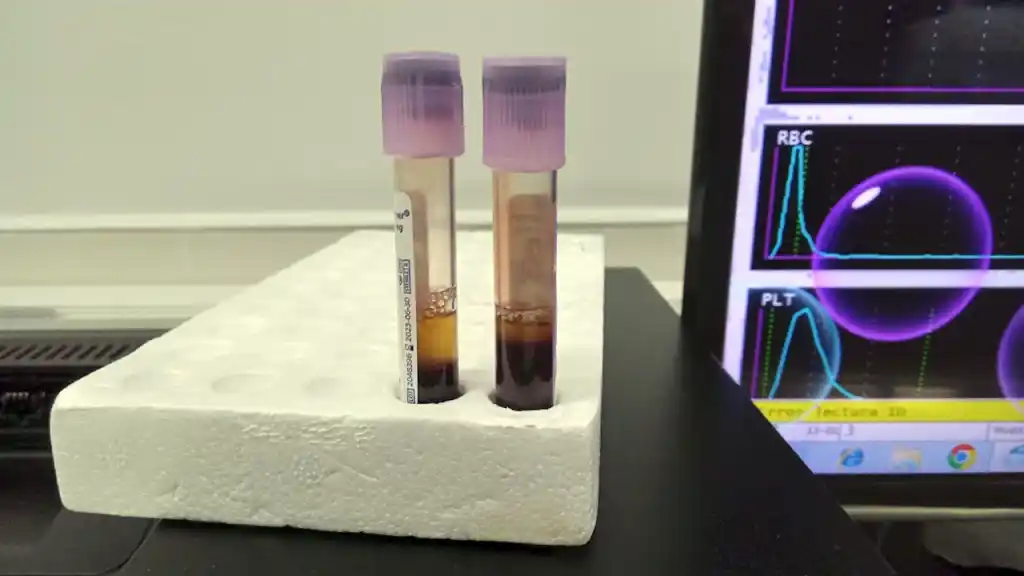 Bioingenieros y médicos lideran un innovador estudio de tratamiento con plasma en pacientes con artrosis de rodilla