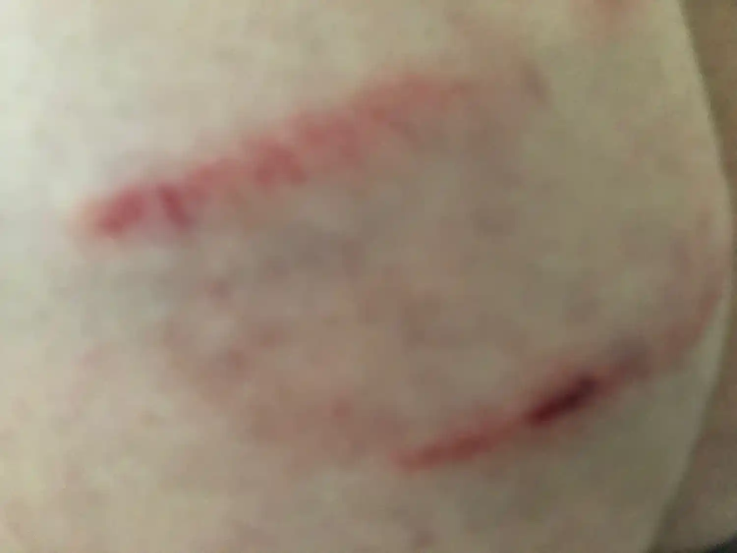 Otro ciudadano fue mordido por un perro