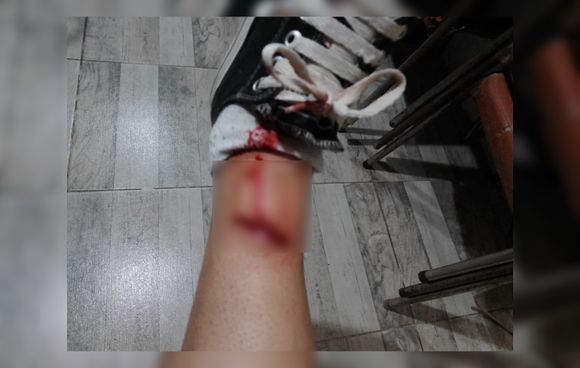 Perros sueltos mordieron a una joven que iba en bici por Litoral, entre Colón y Libertad