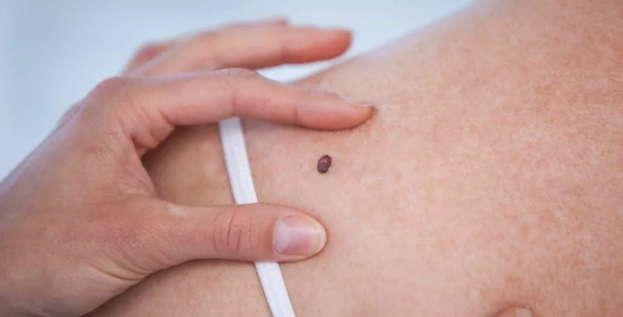 Día del Cáncer de Piel: la importancia de la detección precoz