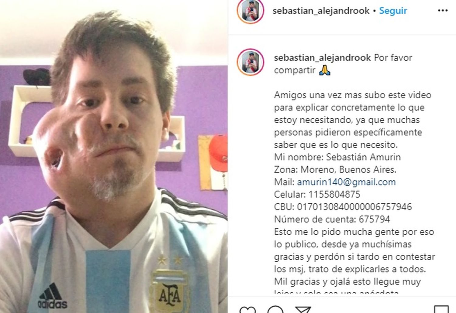 El pedido de un joven con un extraño tumor: necesita operarse en plena pandemia