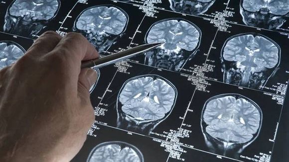 La FDA aprobó un fármaco que demostró ralentizar  el deterioro cognitivo en la primera etapa de la enfermedad
